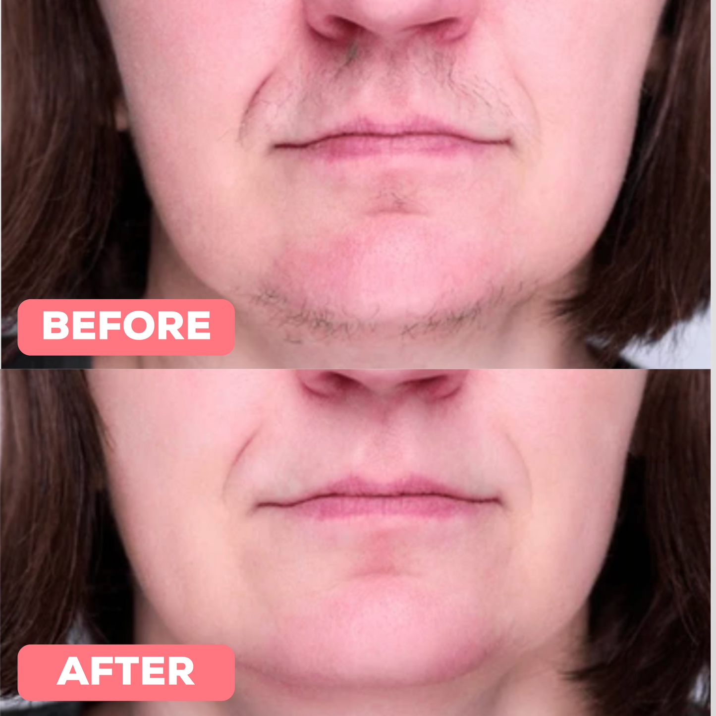 PLuxe Pro Epilator